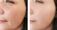 Southampton Cheek Filler Experts - Southampton, Hampshire, United Kingdom